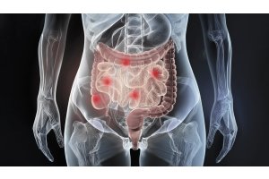 Morbus Crohn: Ursachen und Symptome aus verschiedenen medizinischen Perspektiven