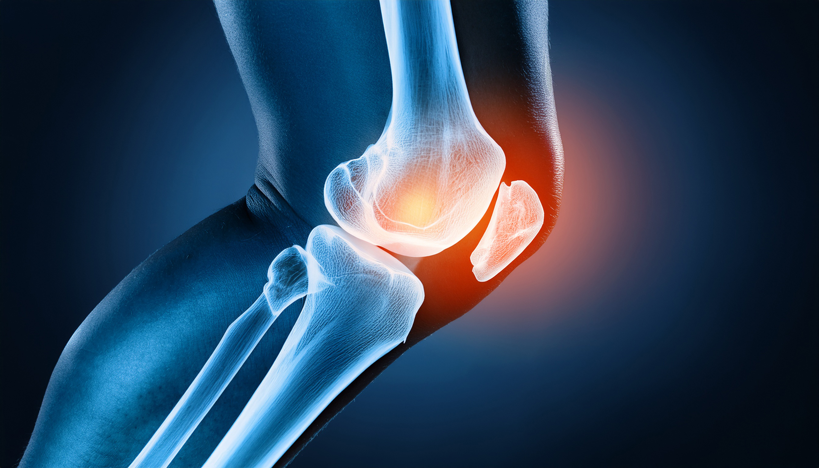 Illustration eines Knies mit Arthrose, bei der die Knochenstrukturen sichtbar sind und ein roter Schimmer auf Entzündung und Schmerz im Gelenk hinweist.